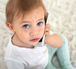 אבעבועות רוח: כל מה שחשוב לדעת-תמונה